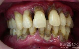 洗牙多久可以吃瓜,洗牙后多久可享美味瓜果?健康饮食时间指南